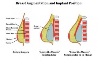 breast augmentation position of implants
