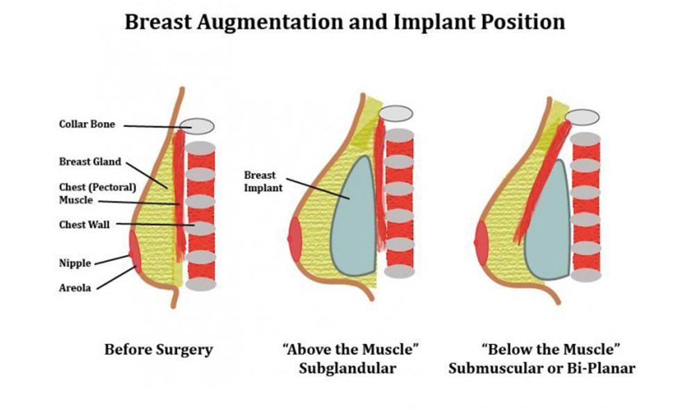 breast augmentation position of implants