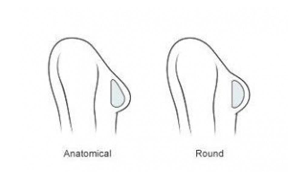 breast implants size2