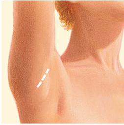 armpit incision