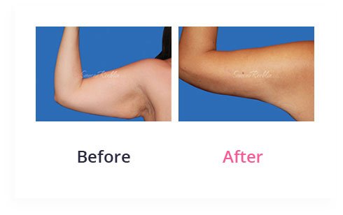 BeforeAfter arm lift