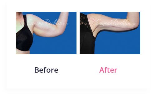 BeforeAfter Arm Lift