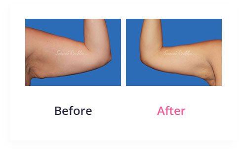 BeforeAfter Arm Lift7