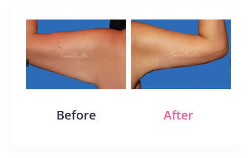 BeforeAfter Arm Lift9