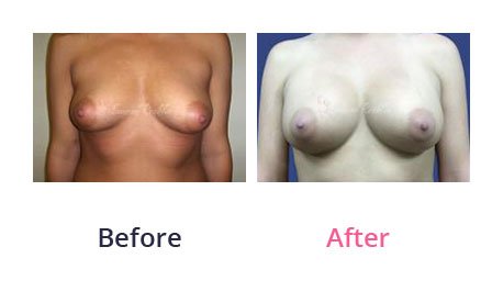 Breast-Augmentation-img-10