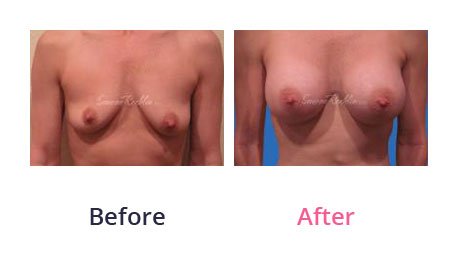 Breast-Augmentation-img-11