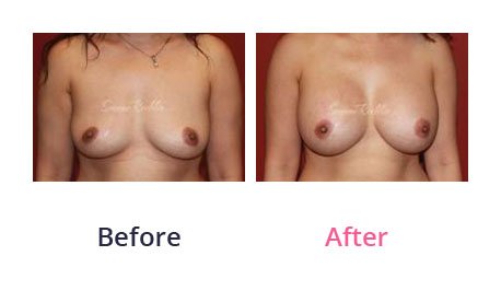 Breast-Augmentation-img-12