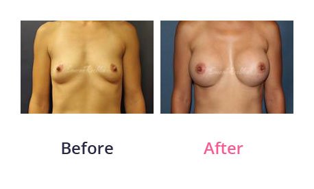 Breast-Augmentation-img-14