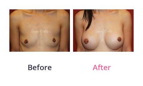 Breast-Augmentation-img-15