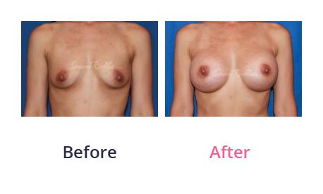 Breast-Augmentation-img-16
