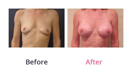 Breast-Augmentation-img-17