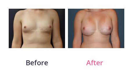 Breast-Augmentation-img-18