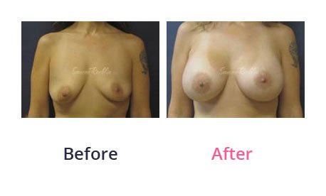 Breast-Augmentation-img-19