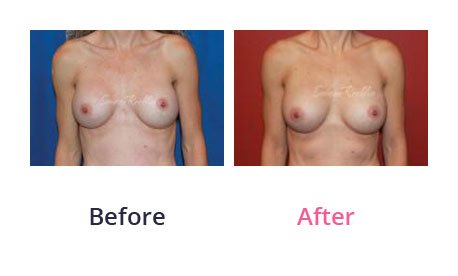 Breast-Augmentation-img-2