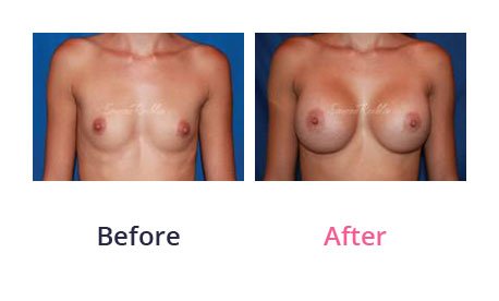 Breast-Augmentation-img-22