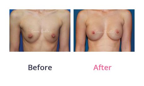 Breast-Augmentation-img-23
