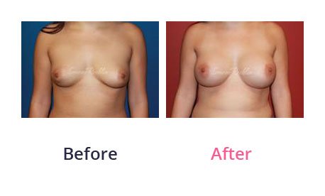 Breast-Augmentation-img-25