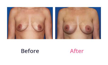 Breast-Augmentation-img-28