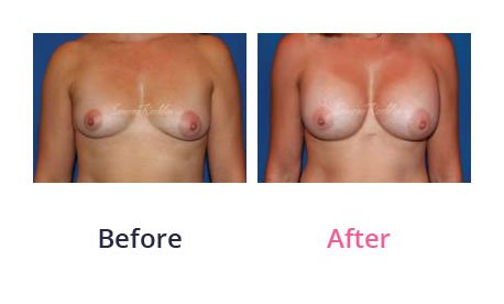 Breast-Augmentation-img-29