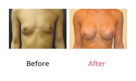 Breast-Augmentation-img-3