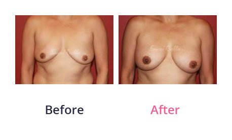 Breast-Augmentation-img-30