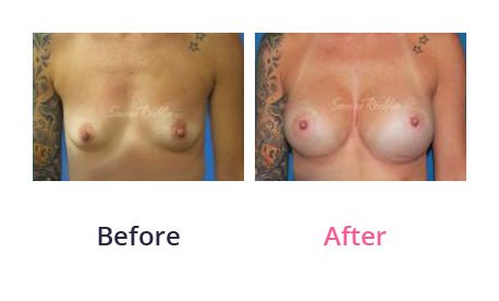 Breast-Augmentation-img-31