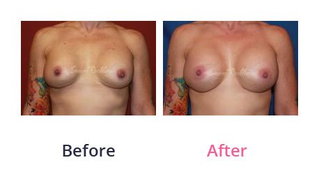 Breast-Augmentation-img-7