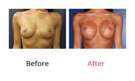 Breast-Augmentation-img-9