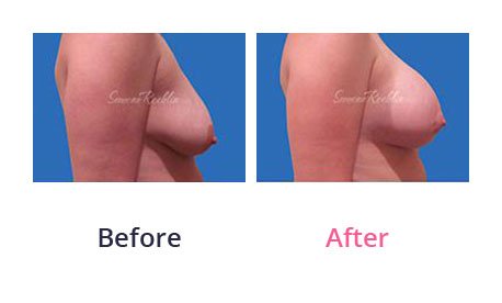 Breast-Lift-img-1