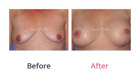 Breast-Lift-img-10