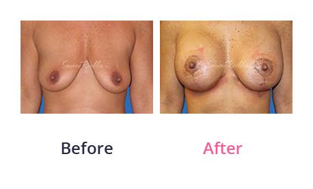 Breast-Lift-img-11