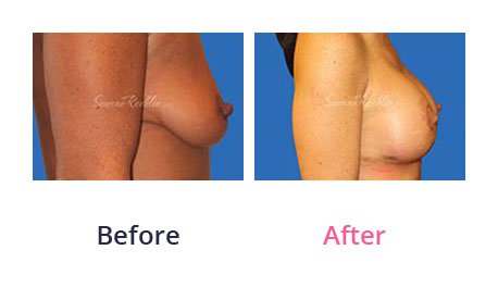 Breast-Lift-img-12