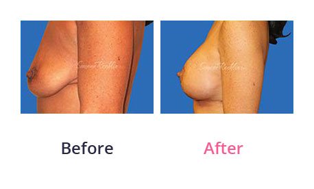 Breast-Lift-img-13