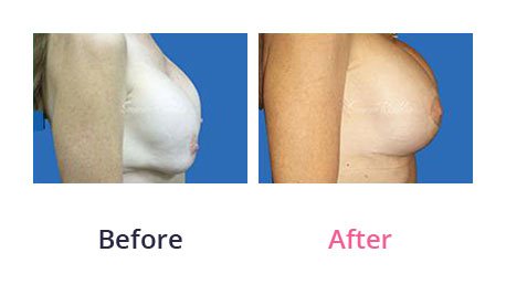 Breast-Lift-img-14