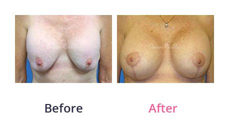 Breast-Lift-img-15