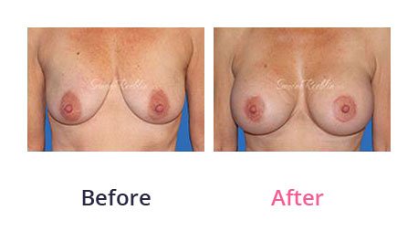 Breast-Lift-img-16