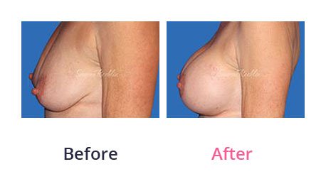 Breast-Lift-img-17