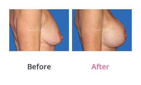Breast-Lift-img-18