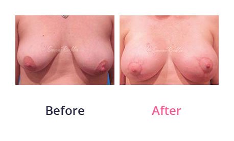 Breast-Lift-img-2