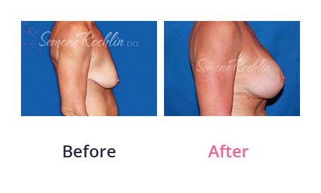 Breast-Lift-img-3