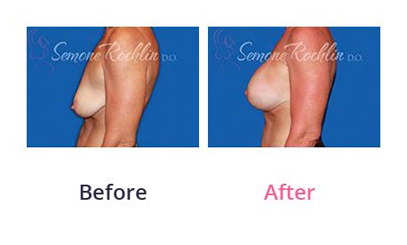 Breast-Lift-img-4