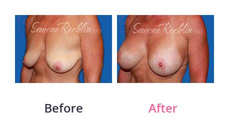 Breast-Lift-img-5
