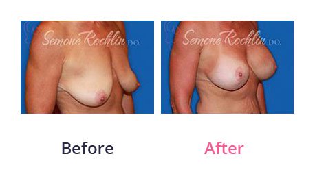 Breast-Lift-img-6