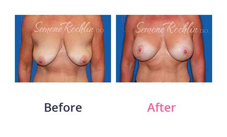 Breast-Lift-img-7