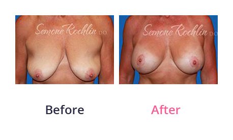Breast-Lift-img-8