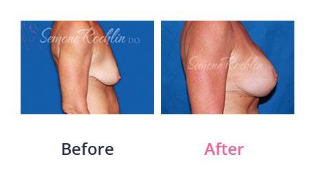 Breast-Lift-img-9
