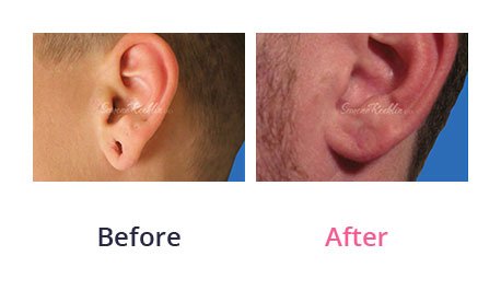 Earlobe-Rapair-img-1