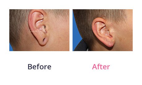 Earlobe-Rapair-img-10