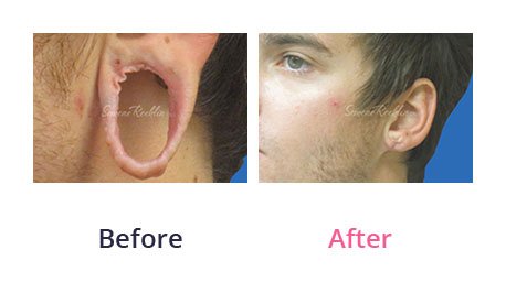 Earlobe-Rapair-img-11