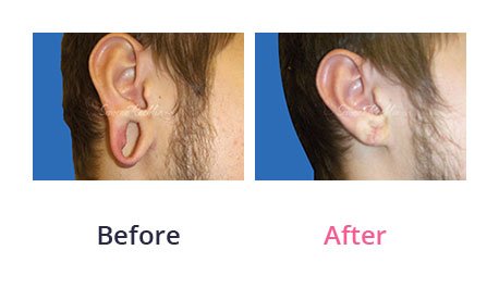 Earlobe-Rapair-img-12